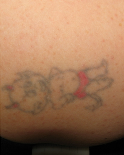 laser tattoo removal Vancouver