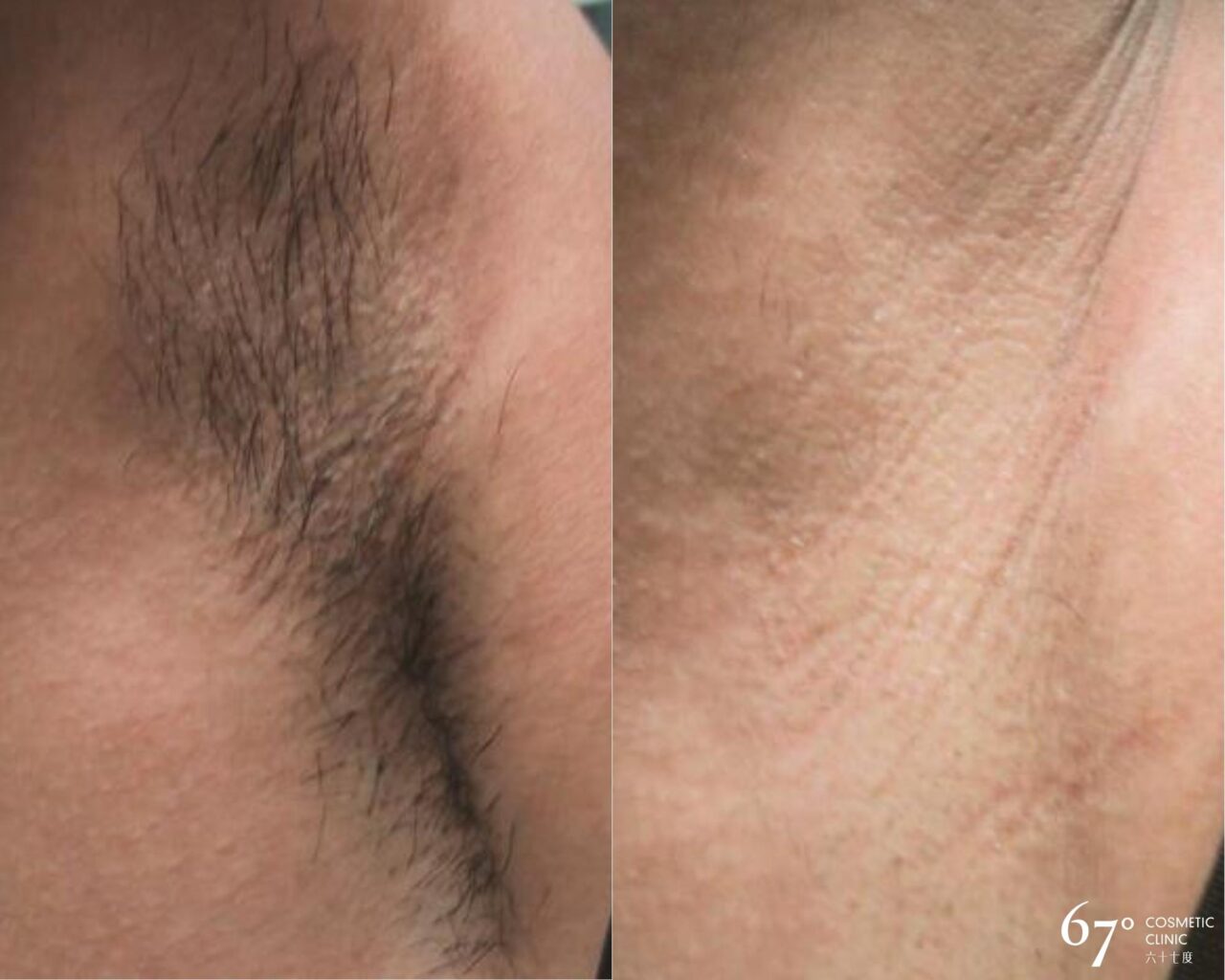 hair removal Vancouver